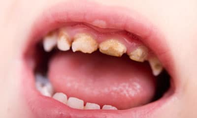 ฟันผุ-เกิดจากอะไร